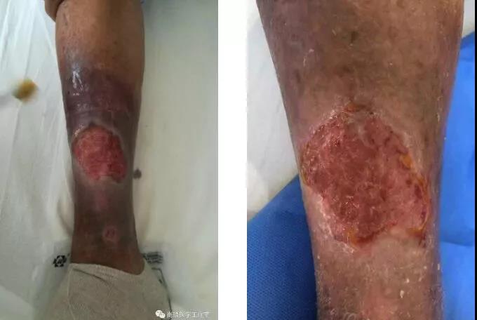 老烂腿4年了......(图1) 老烂腿4年了......(图1)