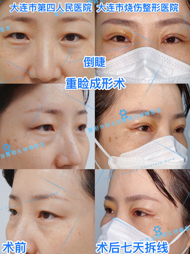 烧伤整形医院的“重睑成形术”———治疗疾病、改善功能、再塑形态(图1) 烧伤整形医院的“重睑成形术”———治疗疾病、改善功能、再塑形态(图1)